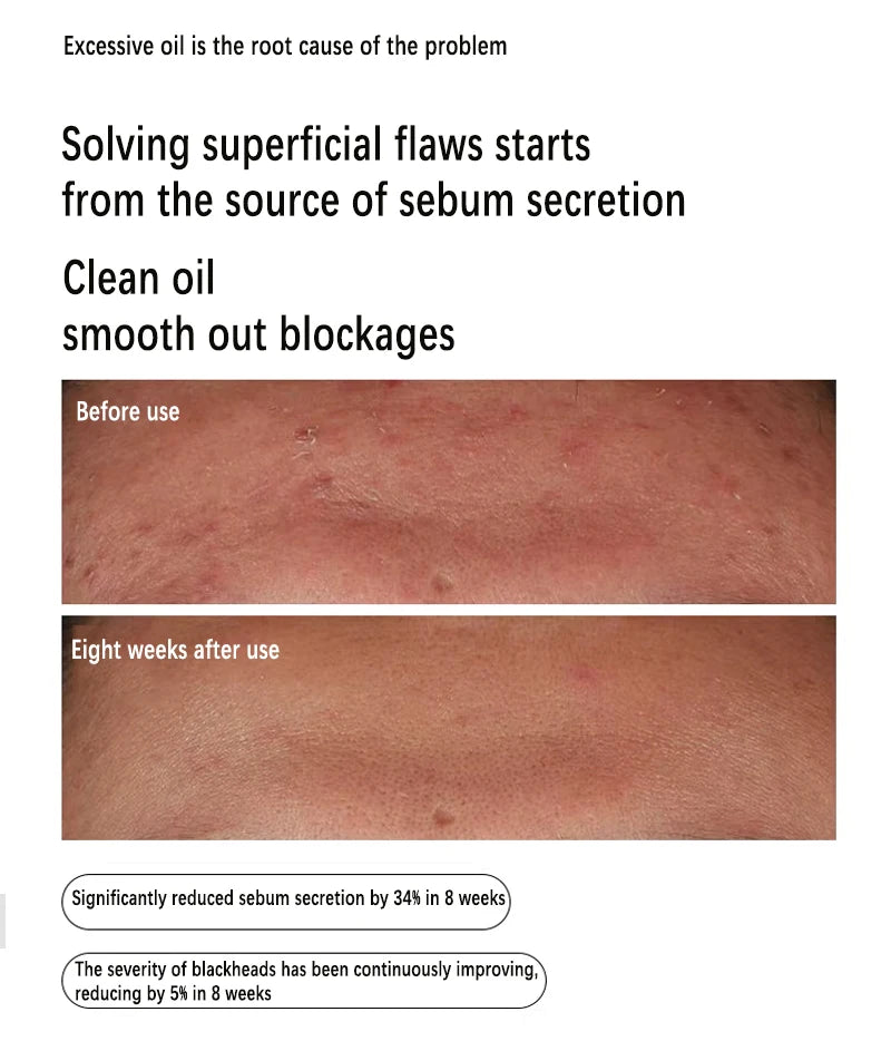 ClearSkin Niacinamide Oil Control Serum